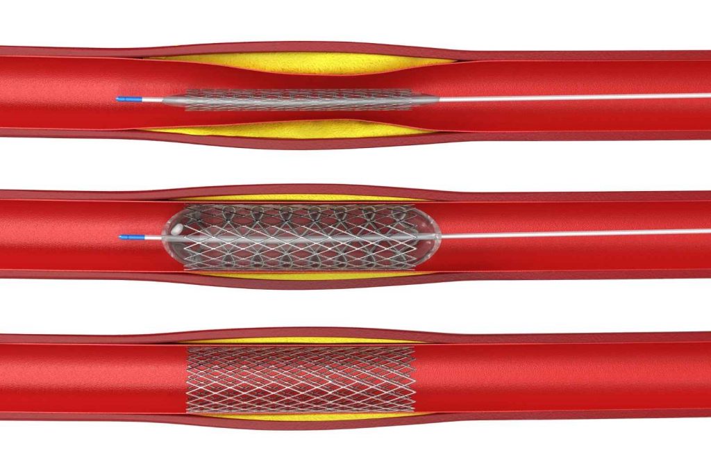 medical implants for the treatment of vascular diseases
