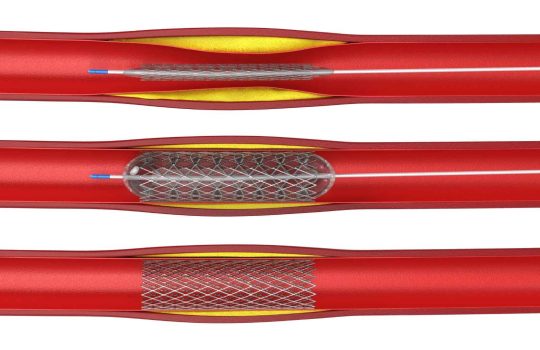 medical implants for the treatment of vascular diseases2